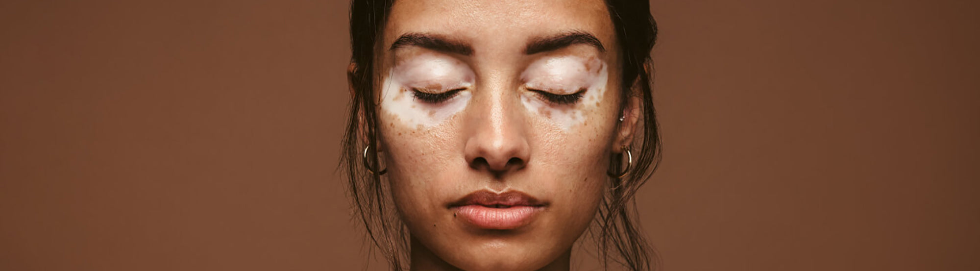 Vitiligo Psoriasis